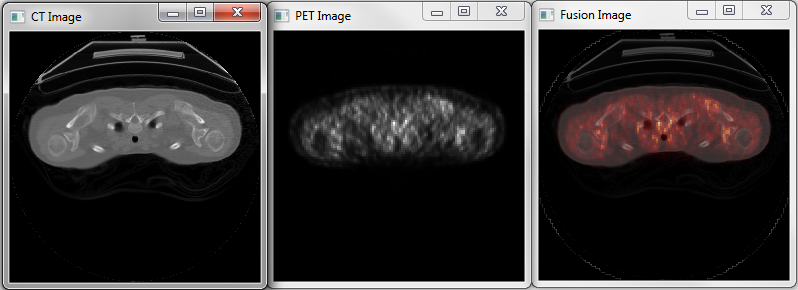Color image overlay of a PET image on top of a CT image.
