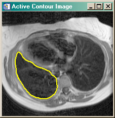 An intermediate stage in active contouring.